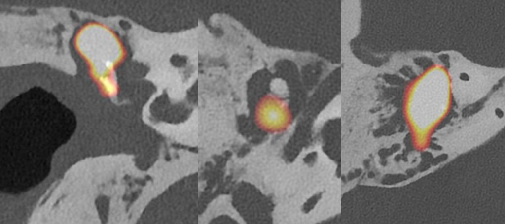 diagnostic du cholestéatome