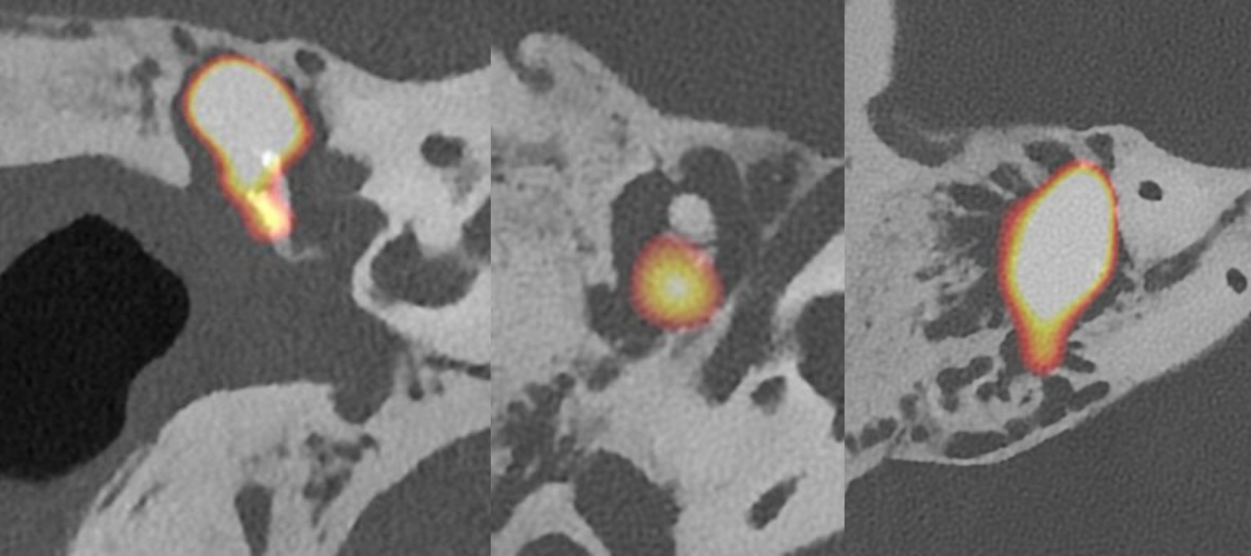 diagnostic du cholestéatome