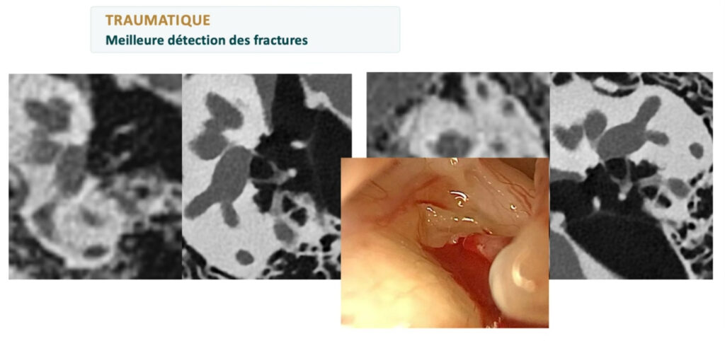 fracture-imagerie