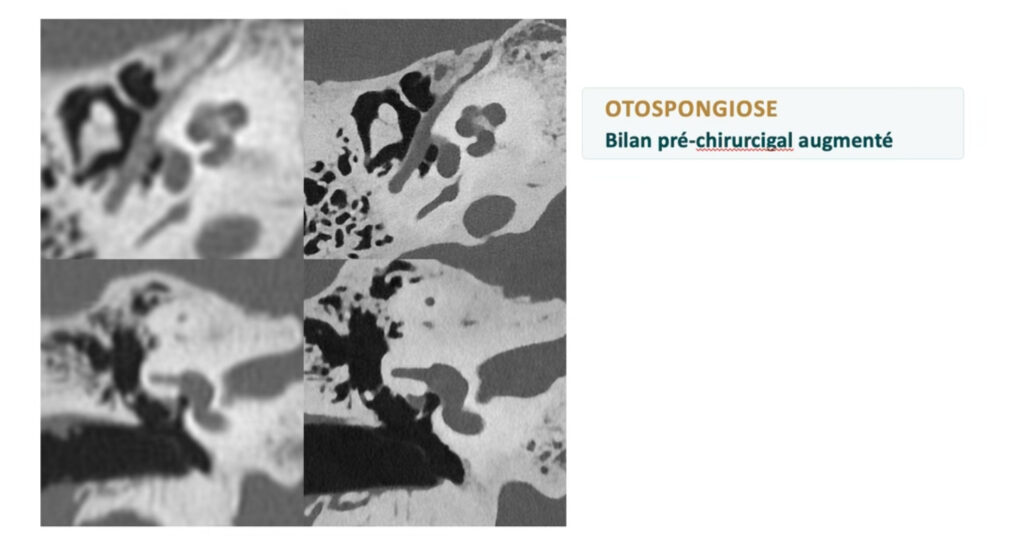 otospongiose