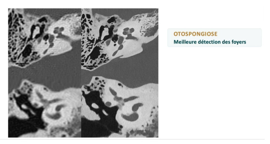 otospongiose