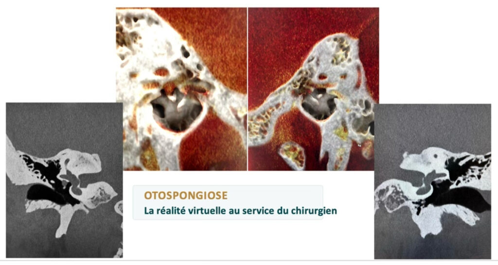 otospongiose