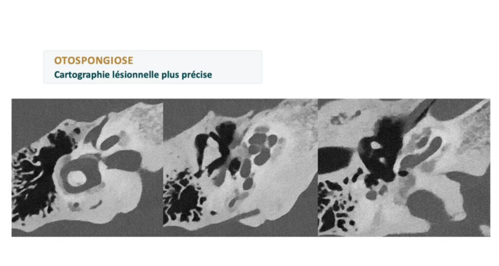 otospongiose