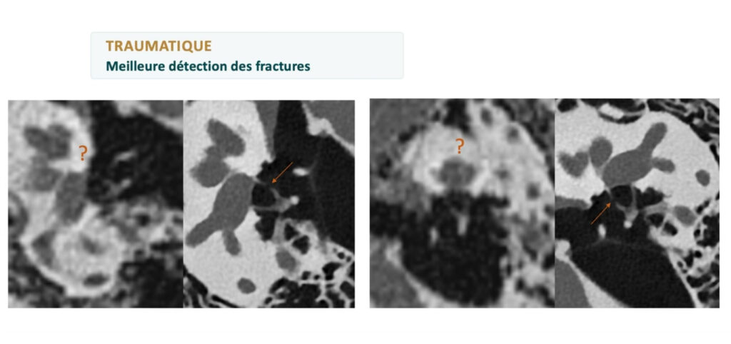 scanner comptage photonique